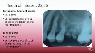 Radiographic interpretation made easy case 14 Dilaceration Solved example [upl. by Gusti]