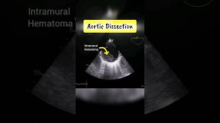 Aortic Dissection and Intramural Hematoma  Echocardiography for Beginners Echo [upl. by Didier]