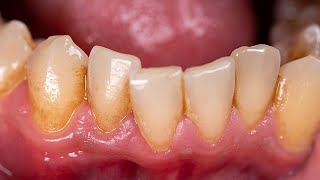 Top 10 Remedies For Dental Plaque [upl. by Abisha]