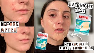 TESTING HYDROCOLLOID BANDAIDS FOR MY ACNE  Hydro Seal Patches  Week Test [upl. by Layap]