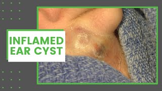 Inflamed Ear Cyst  Dr Derm [upl. by Leesen621]