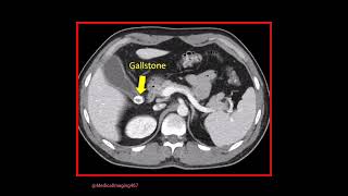 Gall stone at the neck of gallbladder GB stonemedical radiology medicine gastrointestinal [upl. by Ahsyla]