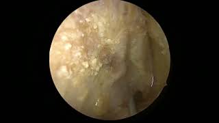 Transorbital approach to middle cranial fossa and cavernous sinus [upl. by Tekcirc]