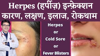 Herpes Infection Of Skin  हर्पीज़ के कारण लक्षण इलाज  Herpes Symptoms Causes Treatment  Hindi [upl. by Tekla]