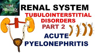 ACUTE PYELONEPHRITIS Pathology [upl. by Ailat]