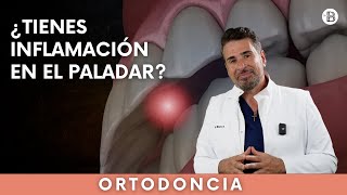 ¿Tienes INFLAMACIÓN en el PALADAR superior [upl. by Defant]