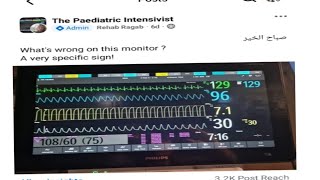 whats wrong in this monitor Dr Rehab Ragab Elseidy Capnogram capnography [upl. by Budd629]