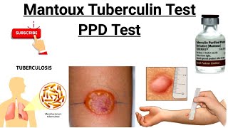 Mantoux Test  Tuberculin Skin Test  PPD Test  Purified protein derivative [upl. by Rae]