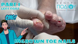 Ingrown ToenailΕίσφρυση όνυχος callus κεντροποδιου footcare podologos podiatrist podiatry [upl. by Weiner769]