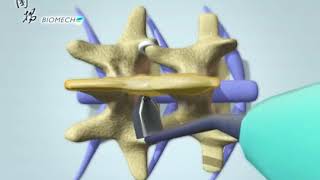 Biomech PAONAN Rocker Interspinous Process System [upl. by Fidellia]