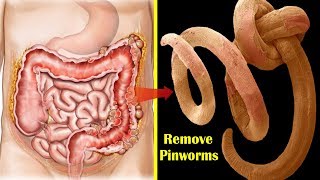 How to Get Rid of Pinworms Overnight  Top 9 Home Remedies for Pinworms During Pregnancy [upl. by Yelrihs]