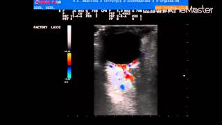 Embolic Central Retinal Artery Occlusion CRAO [upl. by Det]