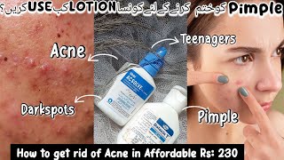 Acne and pimple treatment  Acsolve lotion  Dalacin T lotion  How to get rid of acne and pimples [upl. by Anemij]