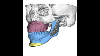 Total Joint Replacement of the TMJs explained [upl. by Lampert]