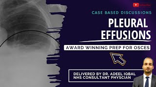 Pleural Effusion Cases  Respiratory  BEST OSCE Preparation for Medical Student Exams [upl. by Eycats576]