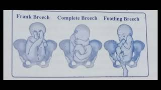 Breech presentation  obg  bsc nursing gnm  obg [upl. by Milburn]