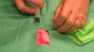 Suturing 1 Infiltrating local anaesthetic [upl. by Yrollam]