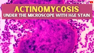 Actinomycosis under the microscope with Haematoxylin and Eosin HampE stain [upl. by Ri140]