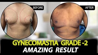 Gynecomastia Surgery in Jaipur  Patient Feedback  Dr Deepesh Goyal  Rejuvena Cosmo Care [upl. by Gnes]