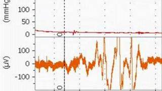 Bupivacaine Cardiotoxicity in an Anesthetized Rat [upl. by Asilej198]