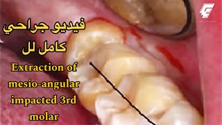 Surgical extraction of Mesioangular impacted 3rd molar  عزت شومان [upl. by Nynahs]