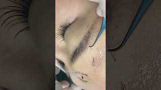 eyebrow transplantation eyebrow eyebrows eyelashes eyebrowtransplantation hairtransplantation [upl. by Uolyram]