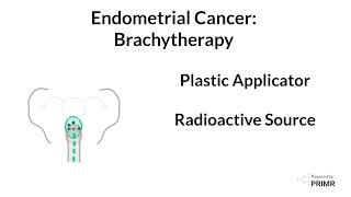 Endometrial Cancer  Brachytherapy [upl. by Onafets]