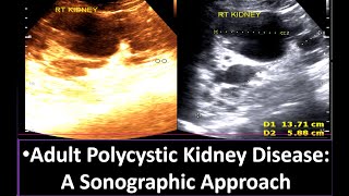 Understanding Adult Polycystic Kidney Disease A Sonographic Approach  Polycystic Kidney Disease [upl. by Arama]