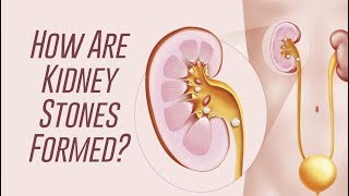 How Kidney Stones are Formed [upl. by Ninaj]