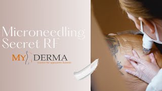 Microneedling mit Radiofrequenztherapie bei MyDerma Dehnungsstreifen Entfernung ohne OP [upl. by Aramahs623]