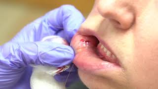 Labial salivary gland biopsy demonstration [upl. by Eleirbag]