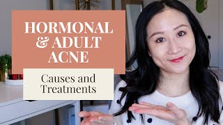 Treating Hormonal Acne  Dermatologist Tips [upl. by Rapsac]