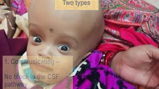 Hydrocephalus in children  Pediatrics [upl. by Colline461]