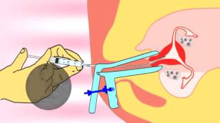 Intrauterine insemination IUI IUTPI the new method of insemination video [upl. by Waldo]