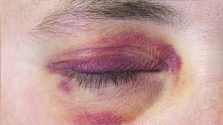 how to get rid of a black eye in 30 minutes [upl. by Eniluqaj512]