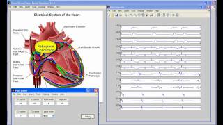 VHM v20 Atrial Flutter simulation [upl. by Justen]