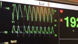 Taquicardia ventricular monomórfica arritmia ventricular [upl. by Buke]