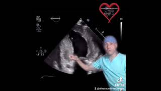 Amyloidosis Cardiomyopathy Echocardiography [upl. by Tricia]