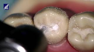 Class I Cavity Preparation Tooth 44 [upl. by Willdon]