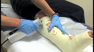 Taking Off a Cast  Medical Assistant Skills Video 9 [upl. by Attiuqehs430]