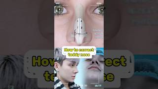 complete procedure of nose surgery [upl. by Leone177]