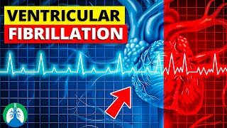 Ventricular Fibrillation Vfib  Medical Explainer Video [upl. by Ramedlaw]