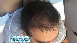 SMP Hairline Density Job Scalp Allure [upl. by Assirrem710]