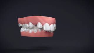 Invisalign Treatment with Mandibular Advancement 11 [upl. by Retepnhoj]