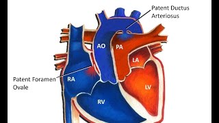 Transposition of the Great Arteries [upl. by Valeda926]