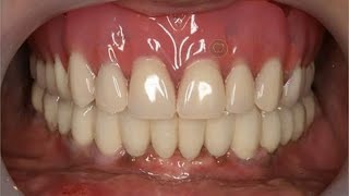 İMPLANT YAPIMI  TAMAMEN DİŞSİZ  ÜST ÇENE FULLGoldenSmileDent [upl. by Nirra]