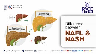 Difference between NAFLD and NASH  NAFLD vs NASH [upl. by Hagep364]