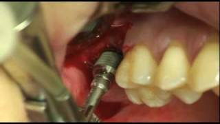 Dentium dental implant prosthetic  17 bicortical IS5mpg [upl. by Vallie]