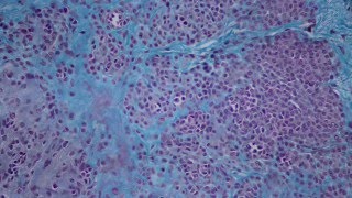 006 Intradermal nevus Histology HEA50 stain [upl. by Llenrub]