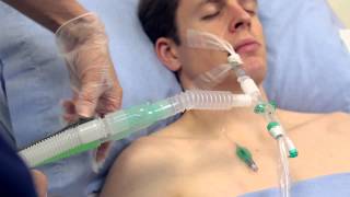 Using Intersurgicals TrachSeal™ closed suction systems [upl. by Jewelle]